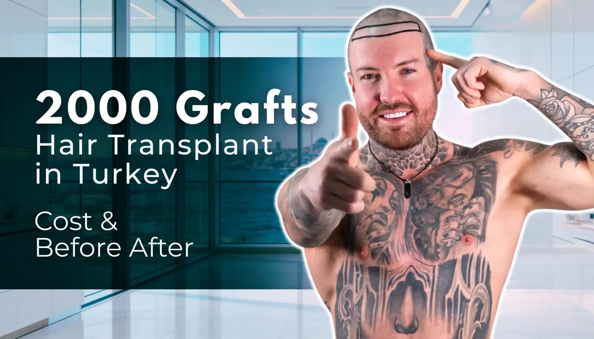 2000 greffons de cheveux transplantés en Turquie hair transplant analysis