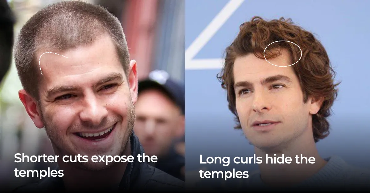 Andrew Garfield Hair Transplant: Did He Get One?