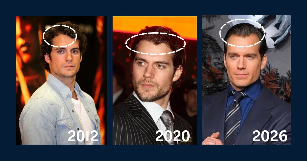 Henry Cavill, hair transplant, grafts, cost, hairline, natural