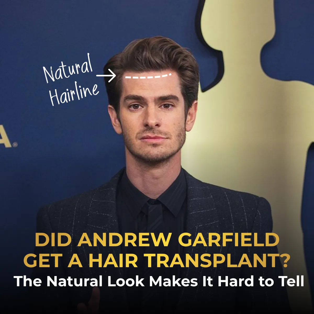 Andrew Garfield Hair Transplant: Did He Get One?