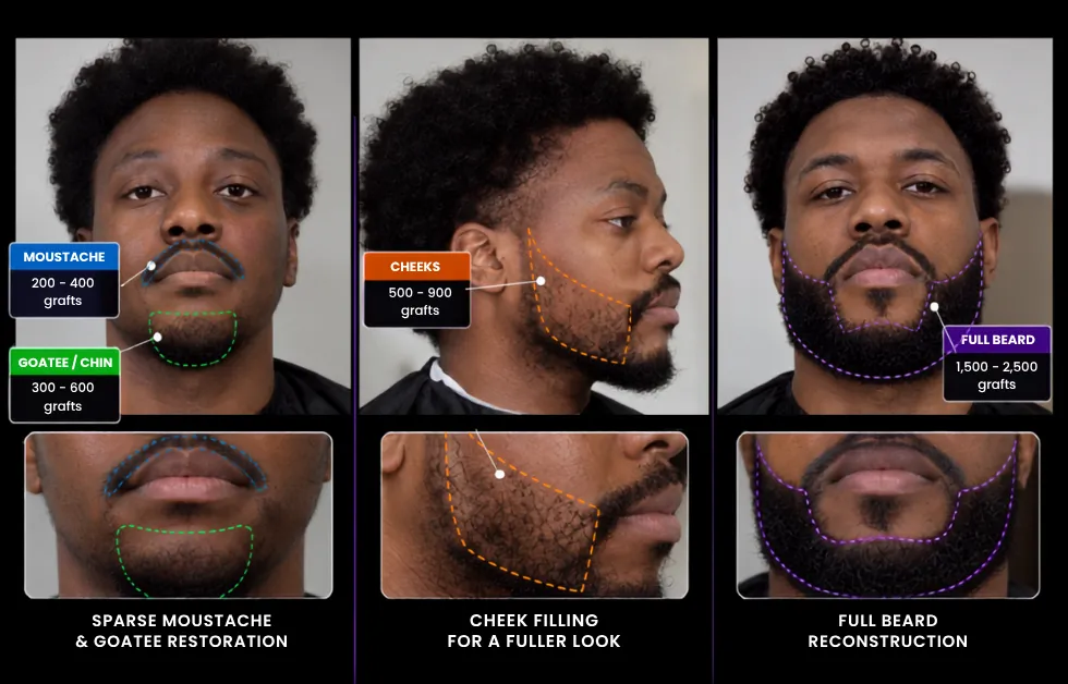 afro beard transplant aftercare, beard transplant safety, Afro hair follicle handling, beard transplant recovery