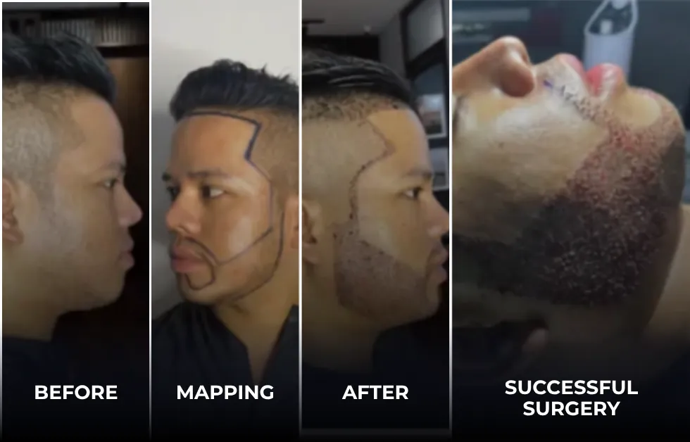 beard transplant timeline, afro beard growth, beard transplant after 12 months, Afro facial hair growth
