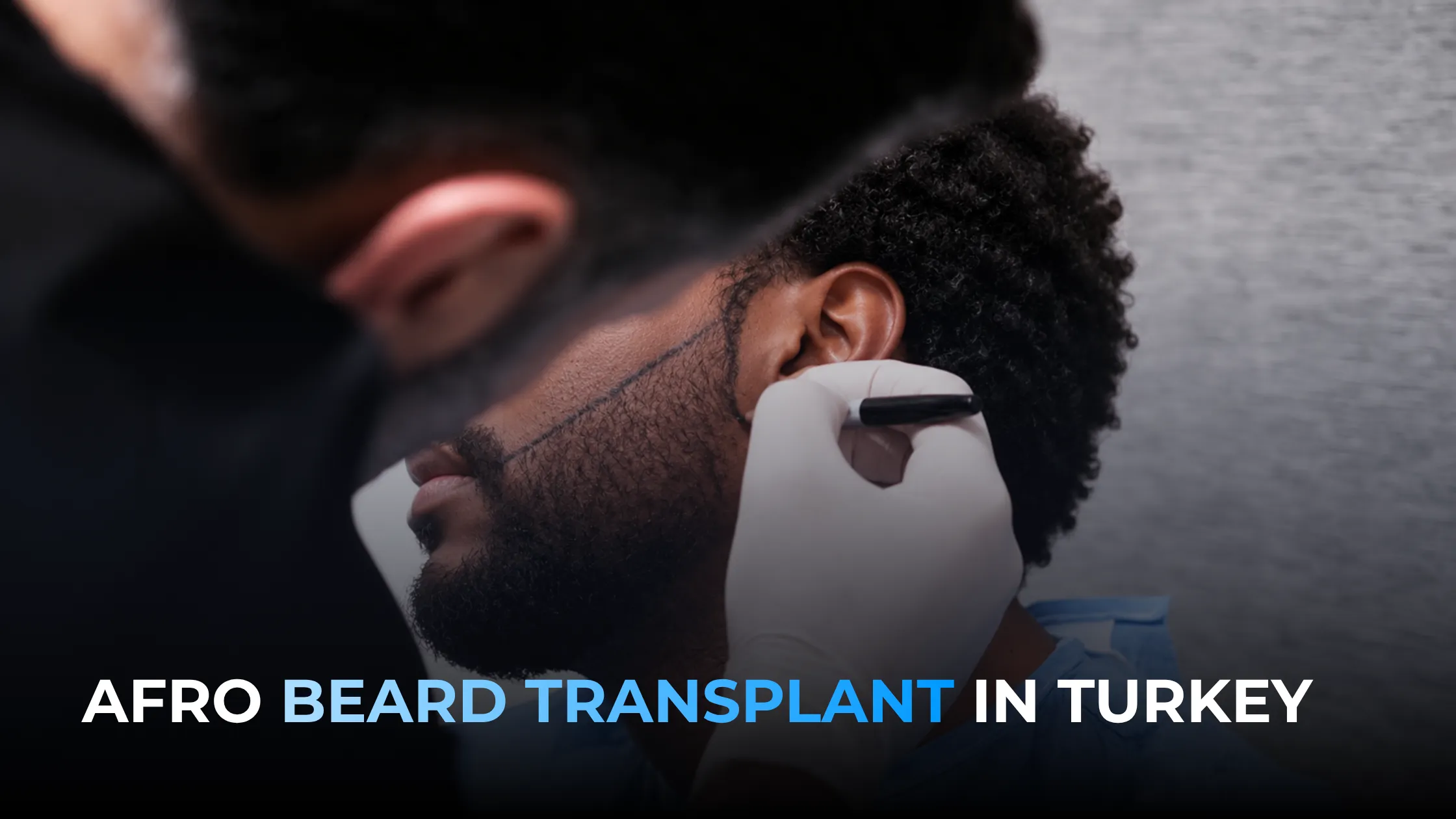 afro beard transplant, patchy beard treatment, Afro beard restoration, beard transplant guide