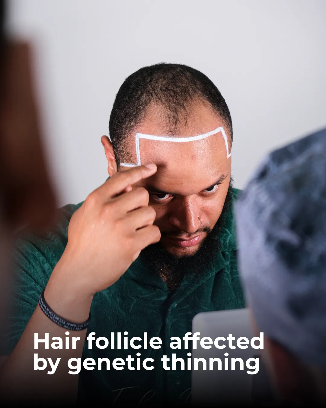 Afro hair transplant consultation, graft extraction plan, Afro graft planning, curly follicle extraction, donor area analysis