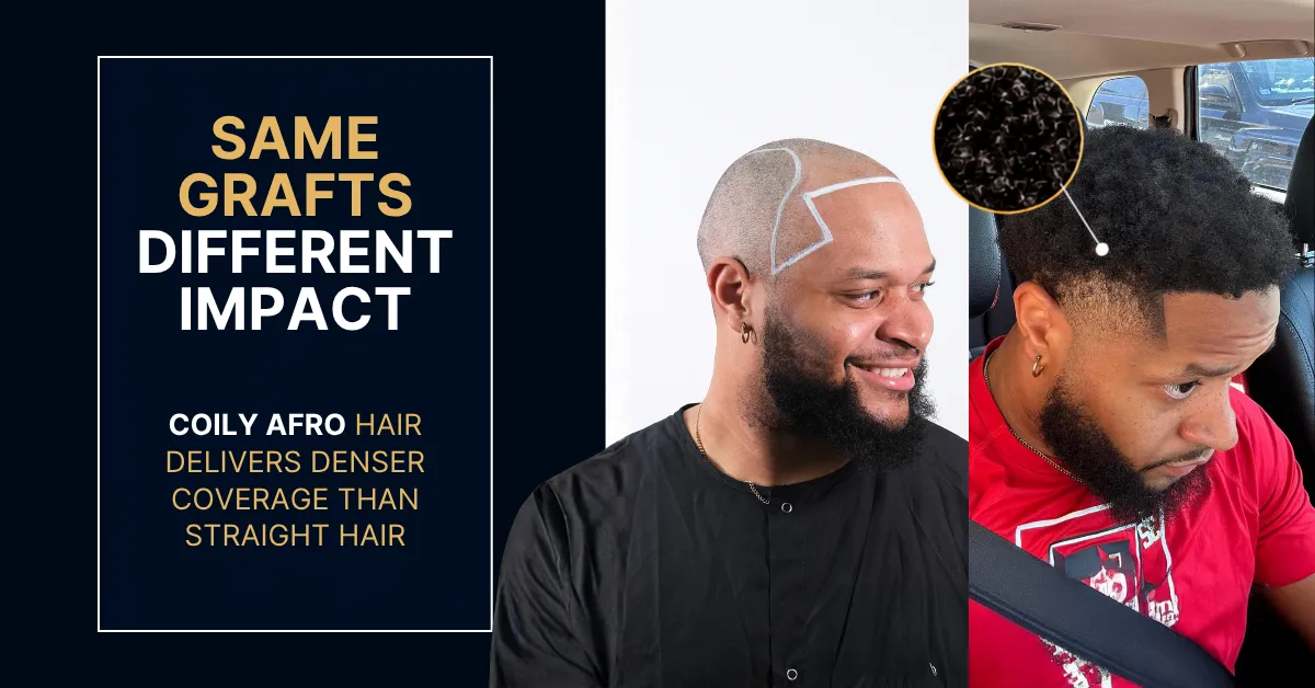 best Afro hair transplant, Afro hair transplant before after, Afro hair restoration result, natural Afro hairline, Afro hair transplant results