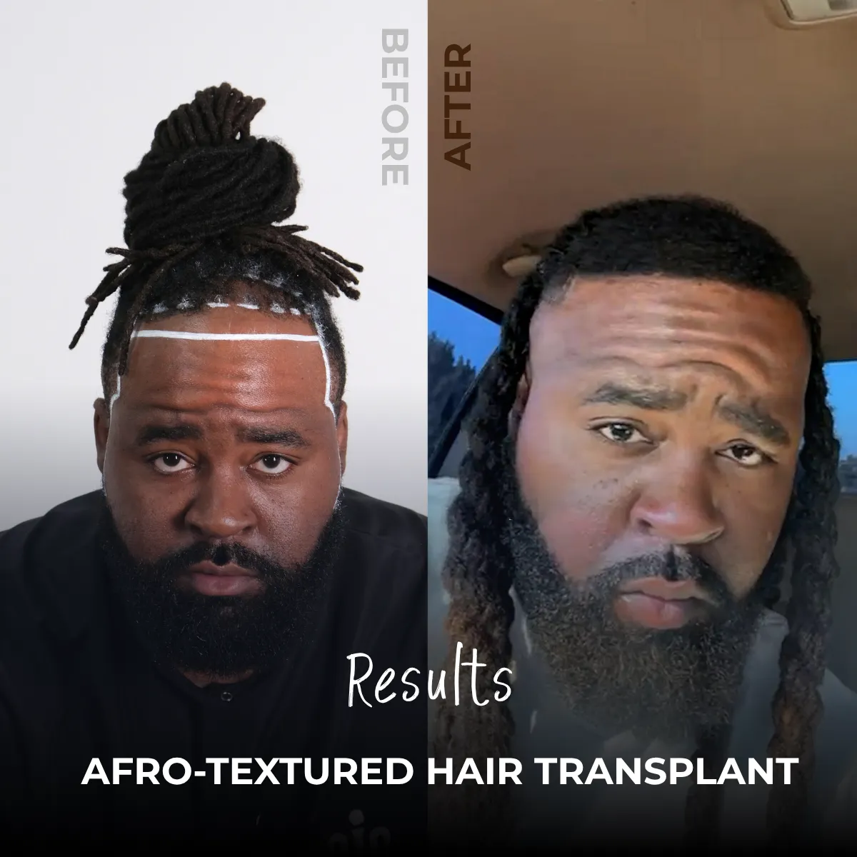 graft distribution hair transplant, hairline design planning, surgical graft count