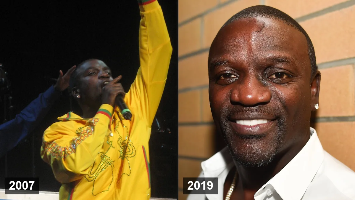 Greffe de cheveux d'Akon hair transplant analysis