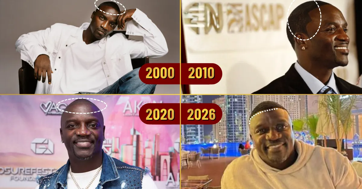 Akon hair loss timeline, Akon hairline evolution, Akon 2000 2026 hair, Akon hair transformation, celebrity hair loss timeline, Akon before after