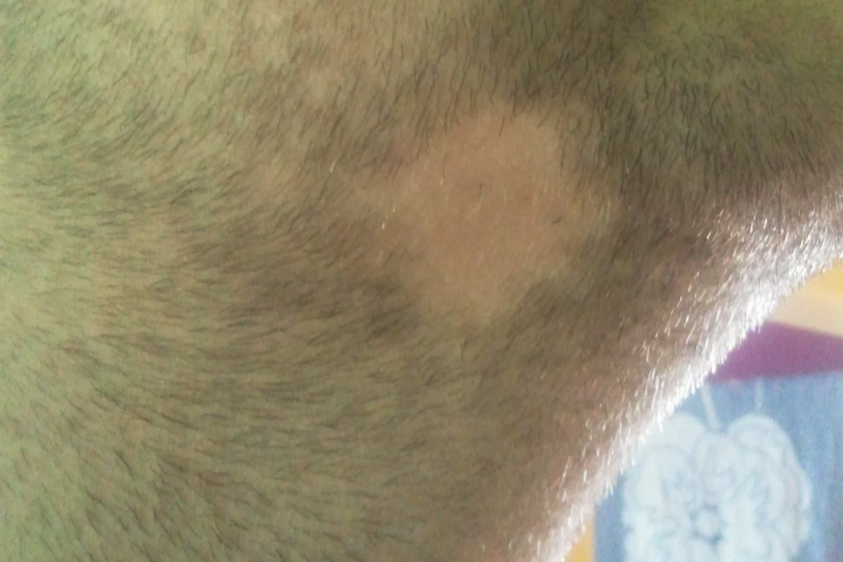 Smooth, round patch of alopecia areata in the beard stubble under the jaw
