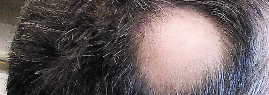Smooth, round bald patch of alopecia areata on the side of a man's scalp