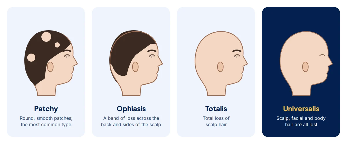 Four head profiles showing patchy alopecia areata, ophiasis, alopecia totalis and alopecia universalis