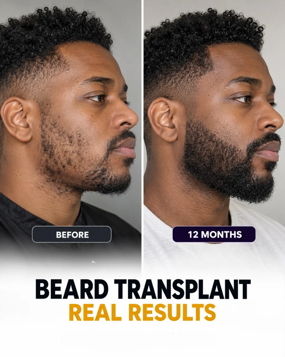 beard transplant before after, beard transplant real result, facial hair restoration, natural beard transplant