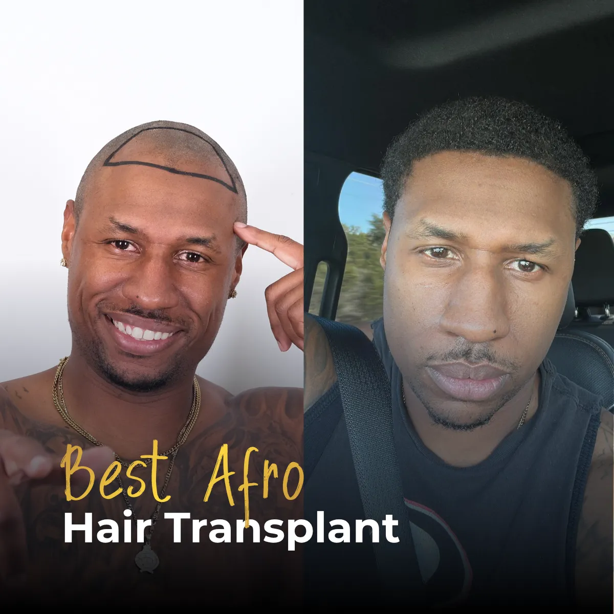 Afro hair transplant grafts, same grafts different impact, curly hair density, Afro hair volume, graft density comparison