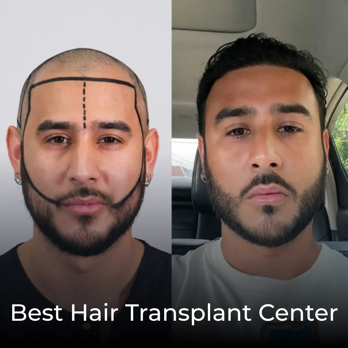 best hair transplant center, hair transplant before after, natural hair transplant results, Turkey hair transplant clinic