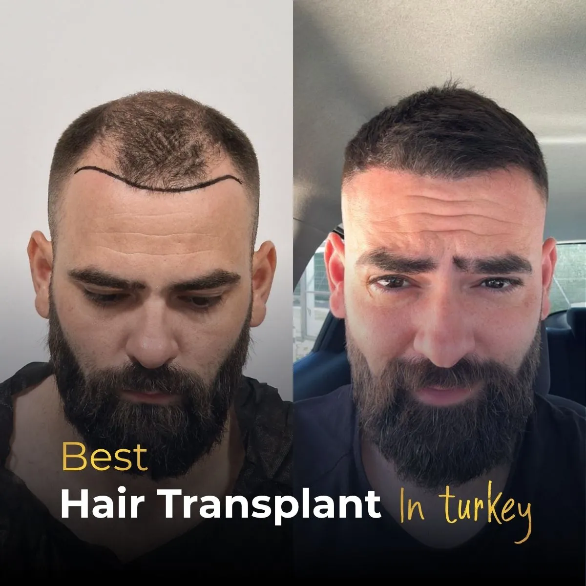 post hair transplant surgery, hair transplant recovery, after hair transplant, post op hair transplant care, hair transplant recovery Turkey, hair transplant healing process, after surgery hair growth, hair transplant patient recovery, hair transplant aftercare, hair transplant healing