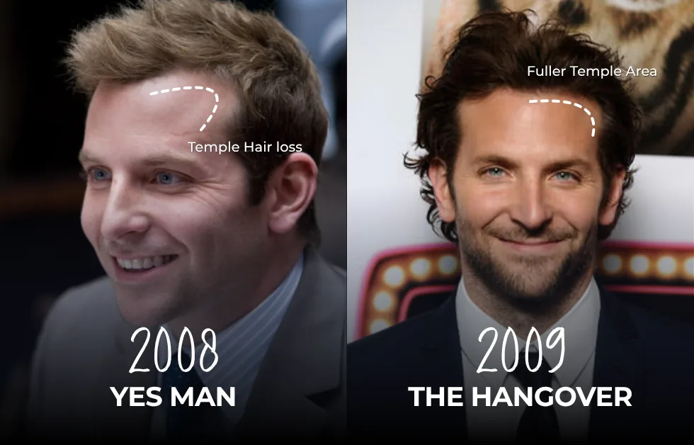 Bradley Cooper hairline in Yes Man (2008) with temple recession compared with The Hangover (2009) with a fuller temple area