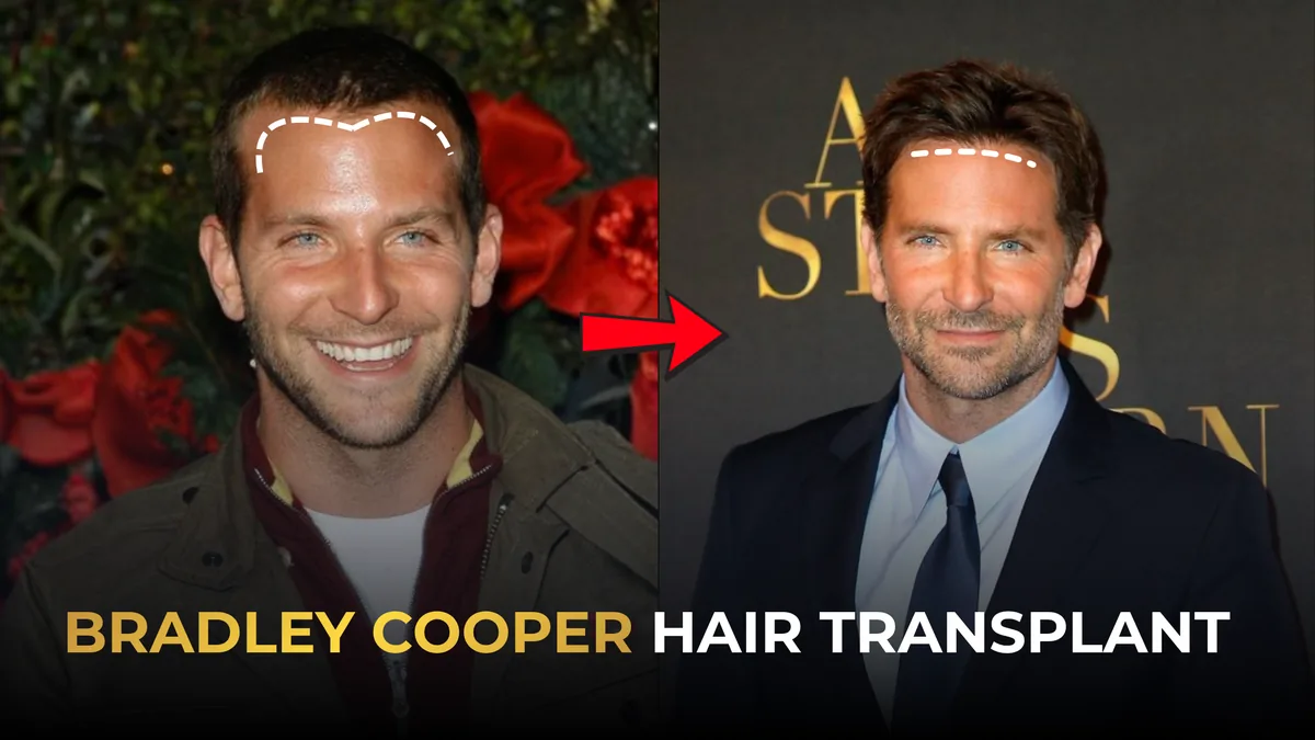 Bradley Cooper hairline before and after: deeper temple corners in the mid-2000s versus a straighter frontal line on a recent red carpet