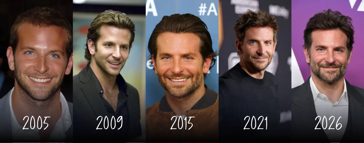 Bradley Cooper hairline timeline in dated photographs from 2005, 2009, 2015, 2021 and 2026