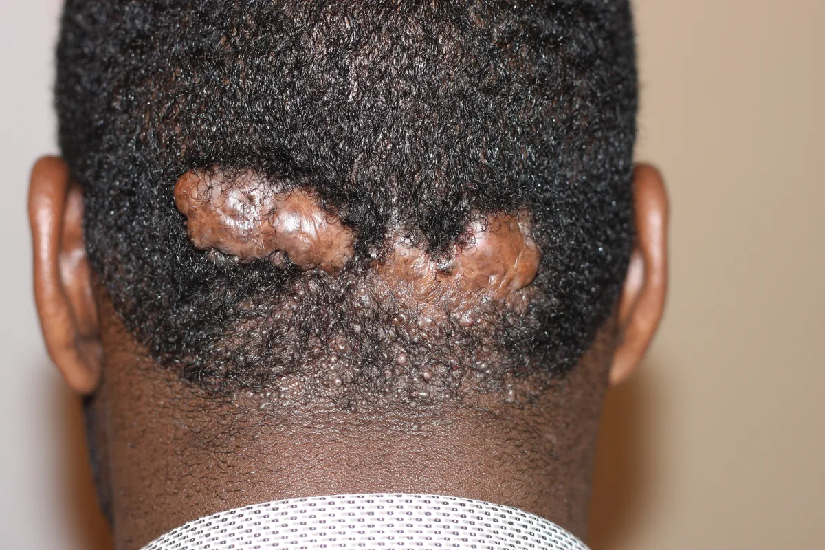 Two firm, shiny, raised lumps of scar tissue across the back of the scalp at the hairline of a man with short black hair