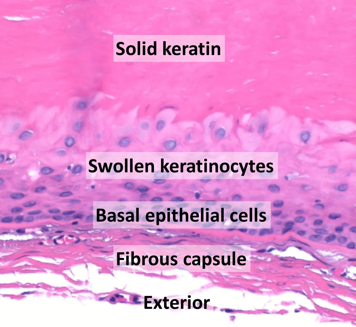 Microscope slide of a trichilemmal cyst wall stained pink and purple, with labels for solid keratin, swollen keratinocytes, basal epithelial cells and the fibrous capsule