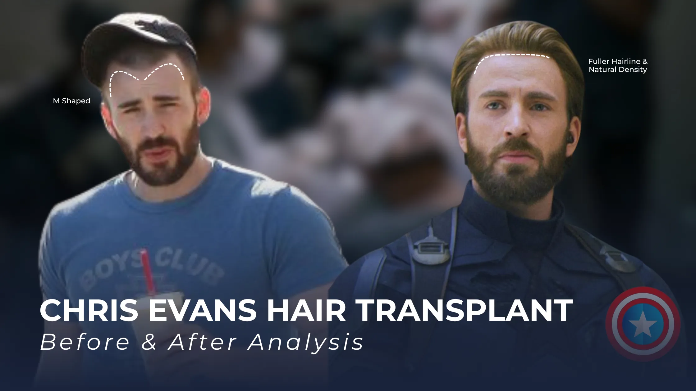 Chris Evans hair transplant before after, Chris Evans before after hairline, Chris Evans hair loss analysis, Chris Evans hairline transformation, celebrity hairline analysis, hair transplant results