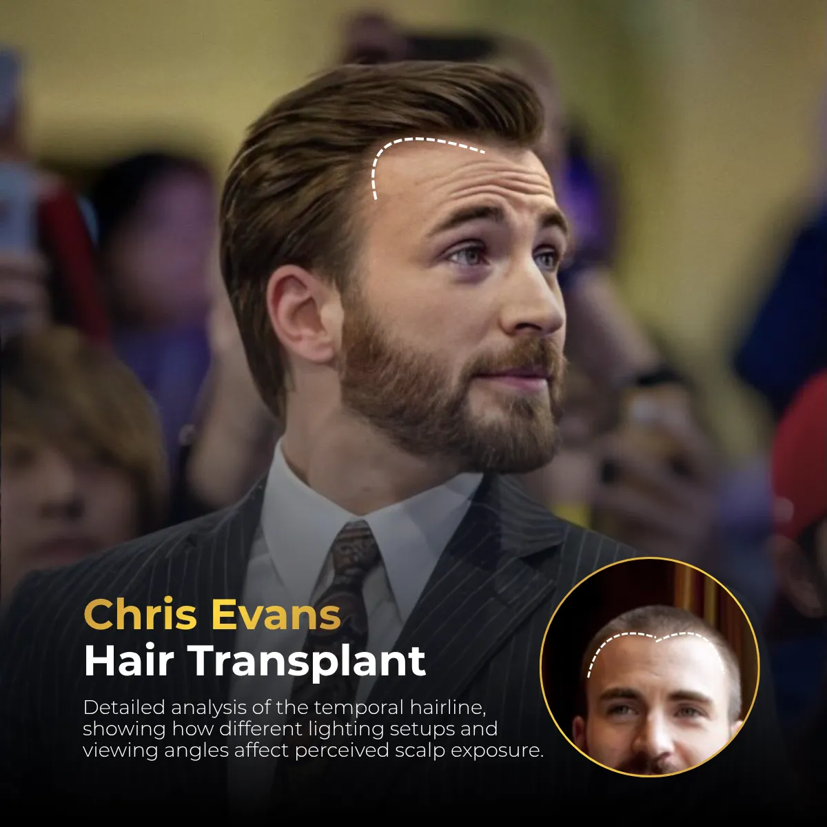 Chris Evans hairline analysis, Chris Evans receding hairline, Chris Evans hair transplant, Chris Evans hair density, Chris Evans frontal hairline, celebrity hair restoration