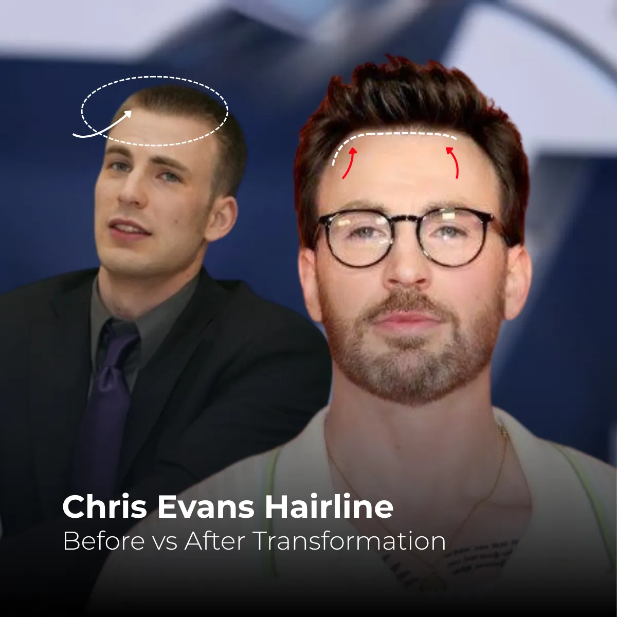 Chris Evans hairline evolution, Chris Evans 2005 2025 hairline, Chris Evans hair loss timeline, Chris Evans hair transformation, celebrity hair timeline, Chris Evans before after hair