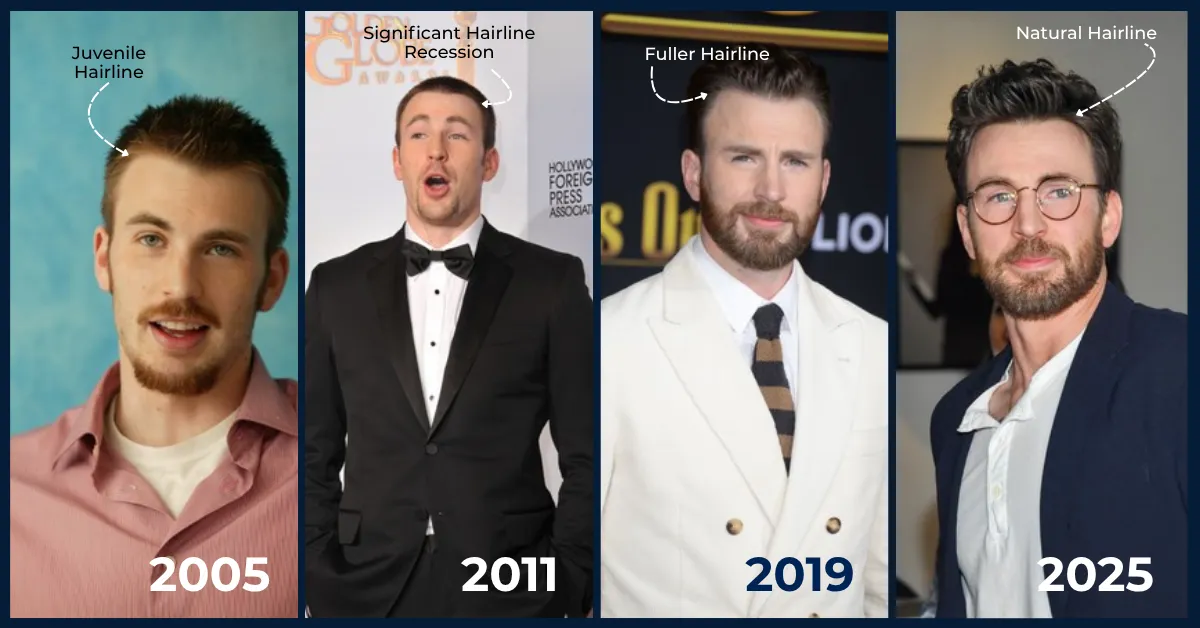 Chris Evans hairline evolution, Chris Evans 2005 2025 hairline, Chris Evans hair loss timeline, Chris Evans hair transformation, celebrity hair timeline, Chris Evans before after hair