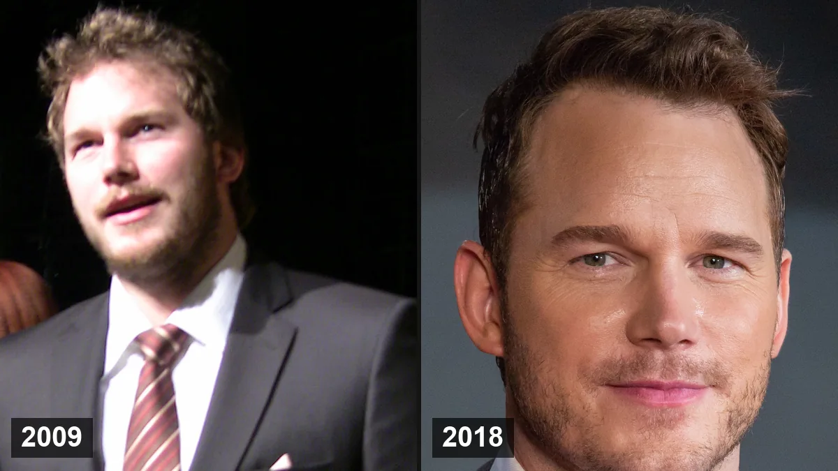 Greffe de cheveux de Chris Pratt: Photos et la vérité sur sa ligne frontale Greffe de cheveux de Chris Pratt: Photos et la vérité sur sa ligne frontale Hair Transplant hair transplant analysis
