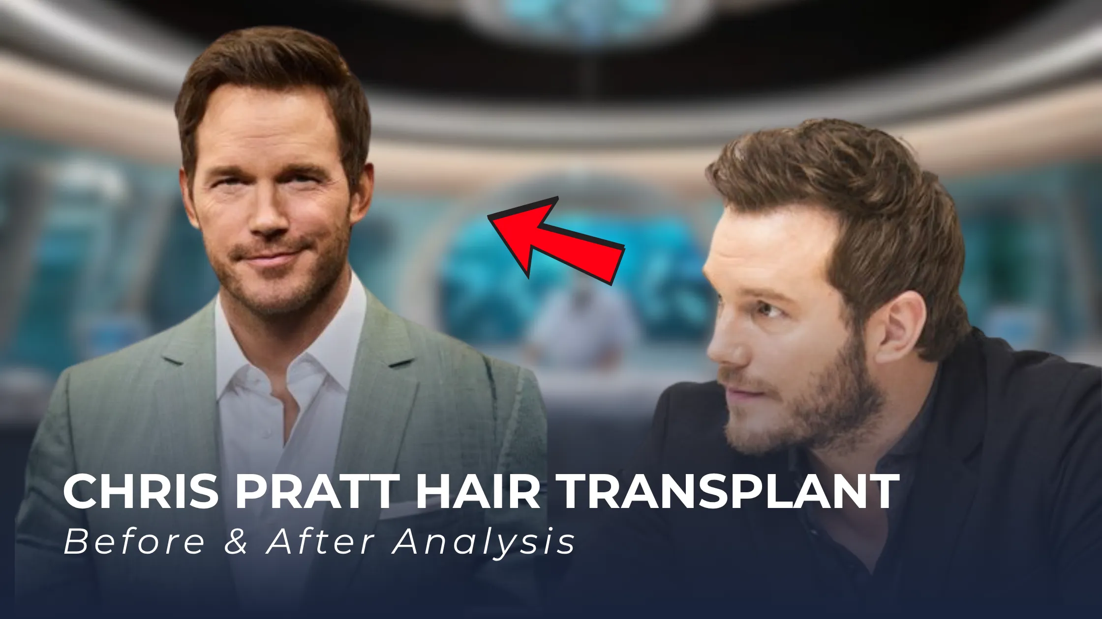 Chris Pratt hair transplant, Chris Pratt before after, Chris Pratt hairline analysis, celebrity hair transplant, hair restoration rumors, hair transplant results