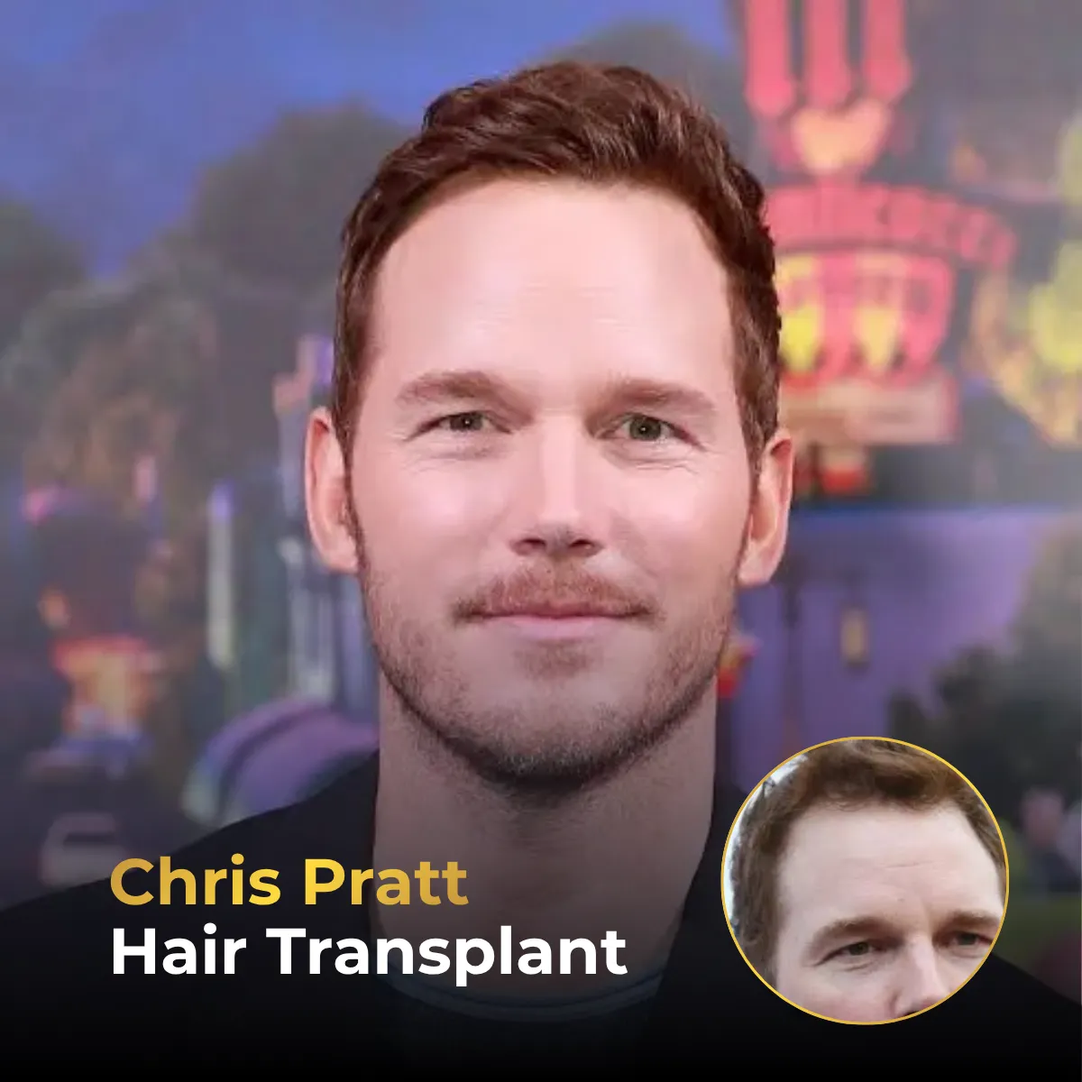 Chris Pratt hairline analysis, Chris Pratt hair transplant, Chris Pratt hair loss, celebrity hair restoration, hairline transformation, hair transplant analysis