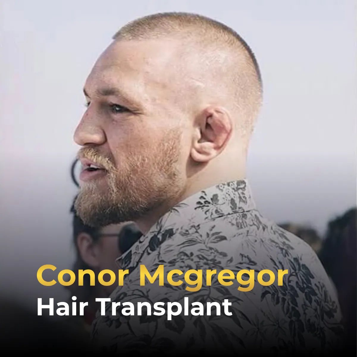 Conor McGregor hair transplant, Conor McGregor before after, Conor McGregor hairline analysis, celebrity hair transplant, hair restoration results, beard and hair transplant