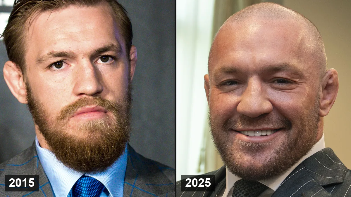 Conor McGregor Greffe de Cheveux: Avant & Après Hair Transplant hair transplant analysis