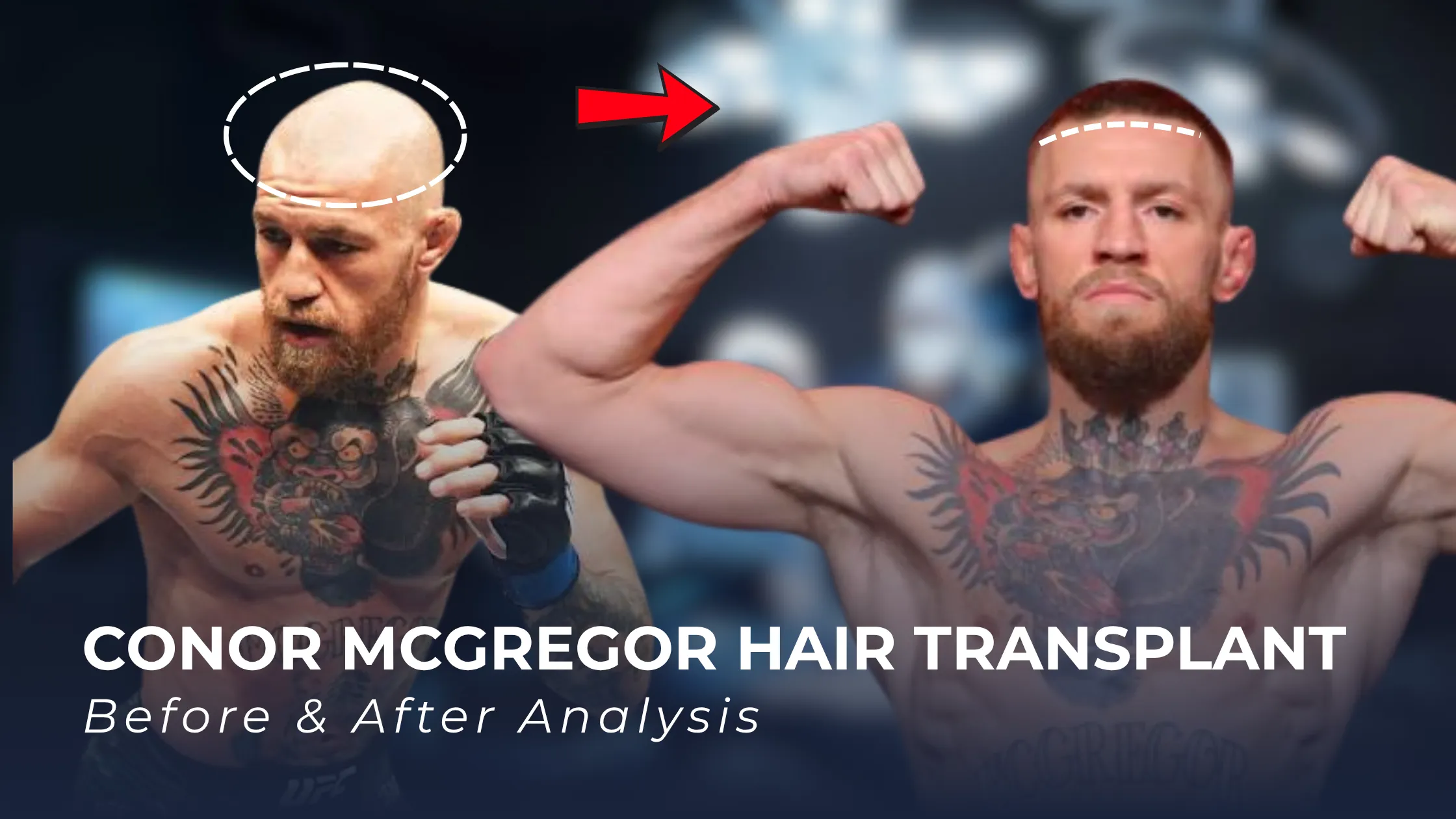 Conor McGregor hair transplant, Conor McGregor before after, Conor McGregor hairline analysis, celebrity hair transplant, hair restoration results, beard and hair transplant