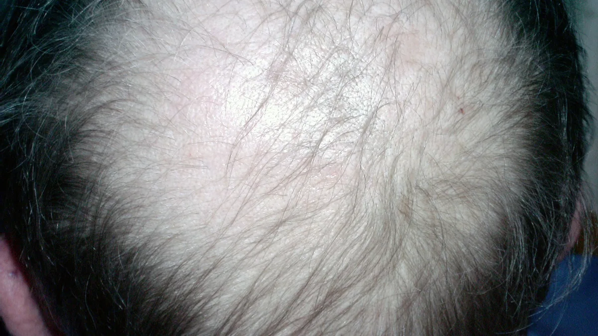 View from above of a man's crown where fine grey and dark hairs are spread thinly over a wide area of scalp