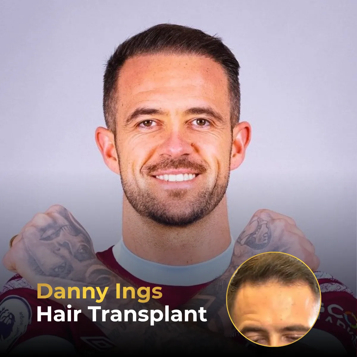 Danny Ings hair transplant, Danny Ings hairline analysis, footballer hair transplant, Danny Ings before after, hair restoration results, hairline transformation