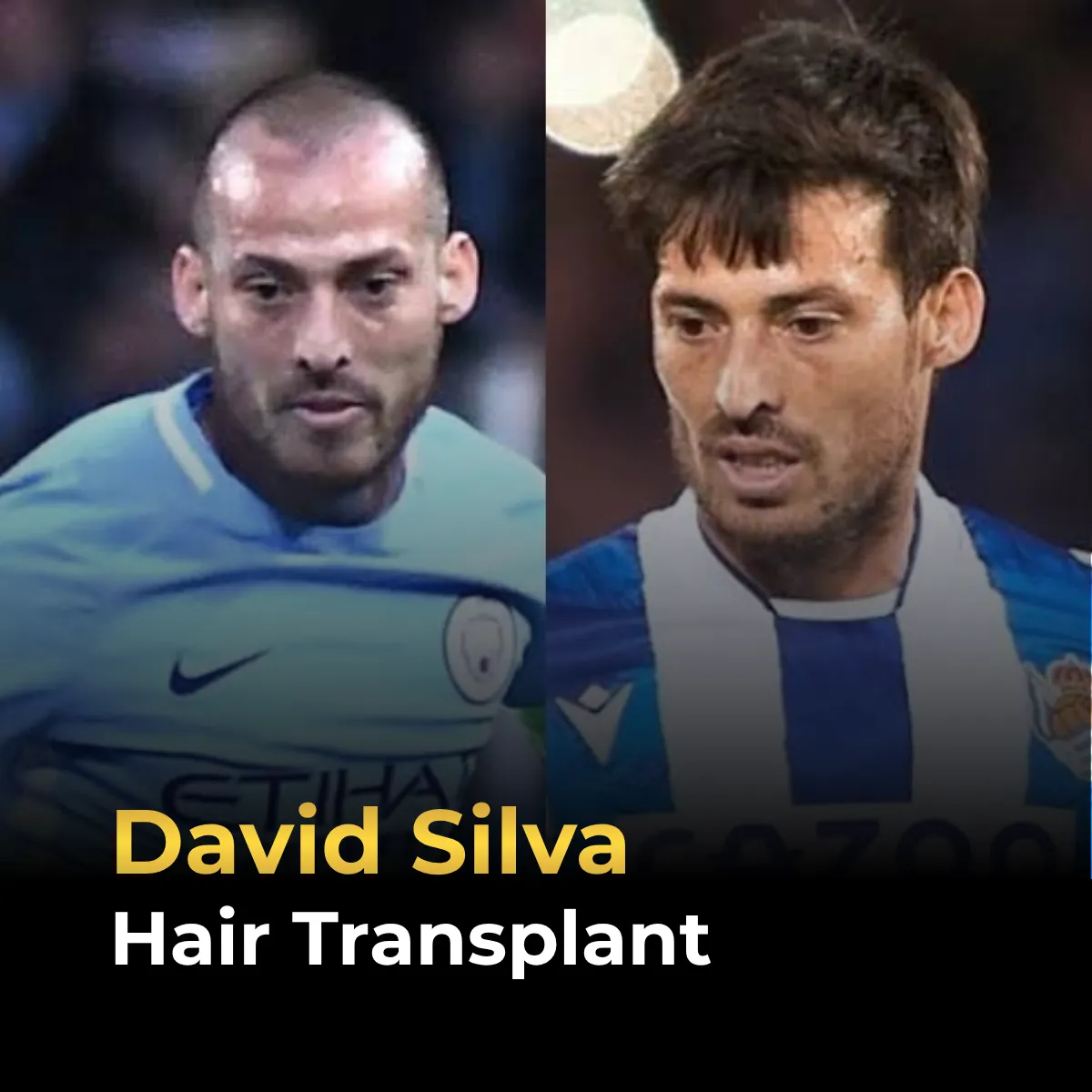David Silva hair transplant, David Silva before after, footballer hair transplant, David Silva hairline analysis, hair restoration results, celebrity hair transplant