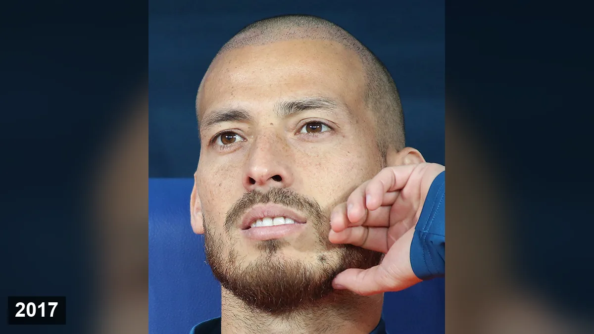 David Silva Greffe de Cheveux: Avant & Après Hair Transplant hair transplant analysis