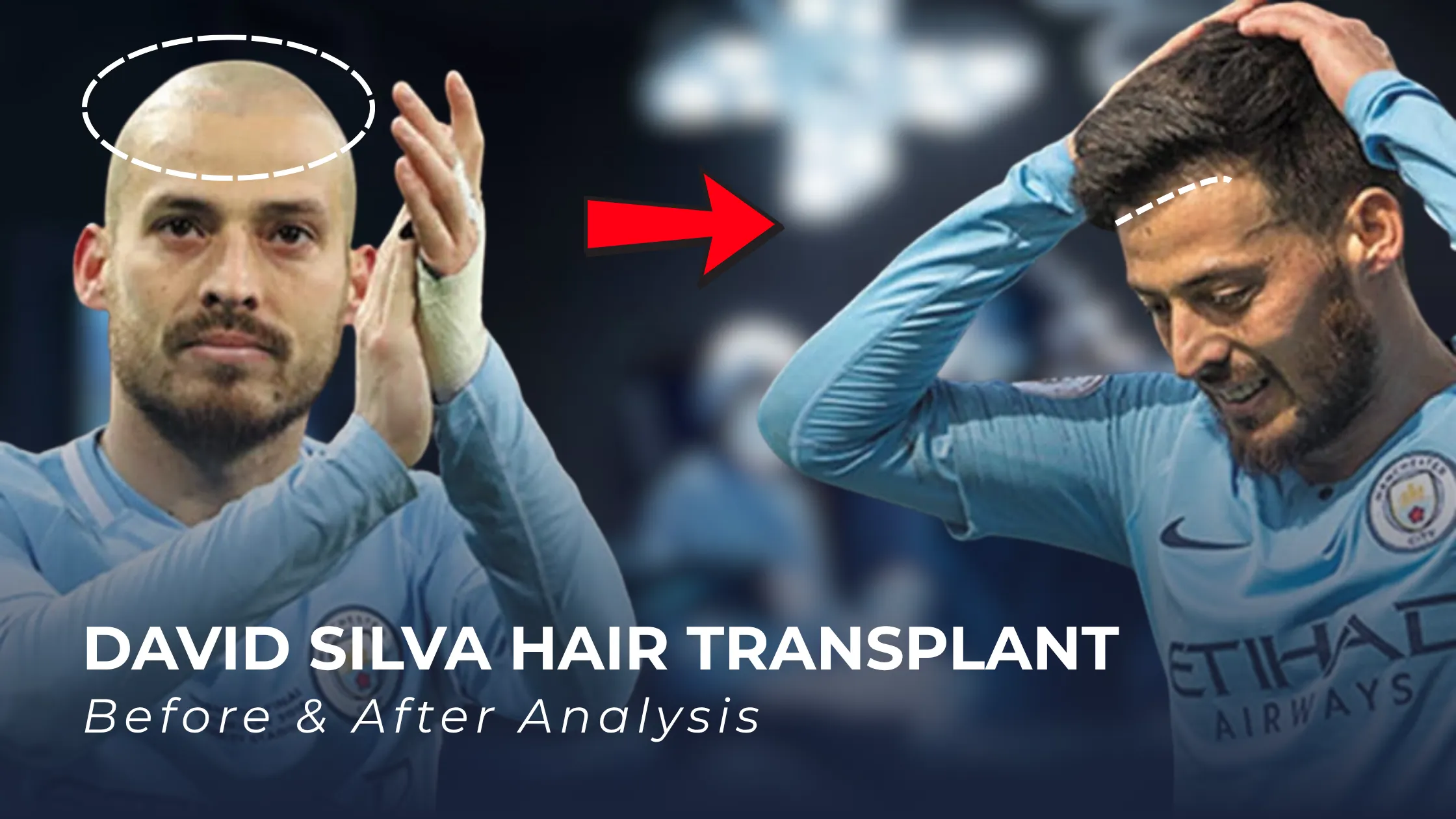David Silva hair transplant, David Silva before after, footballer hair transplant, David Silva hairline analysis, hair restoration results, celebrity hair transplant