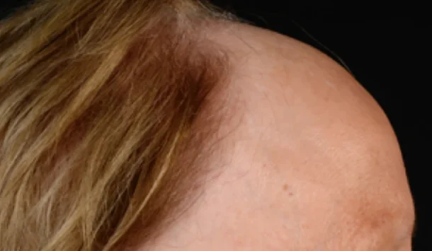 Side view of a woman's head: the hairline has receded far back from the temple, leaving bare skin in front of the remaining hair
