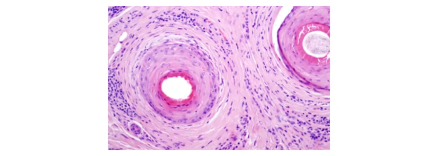 Microscope section of two hair follicles in frontal fibrosing alopecia, each ringed by layers of fibrous tissue and inflammatory cells