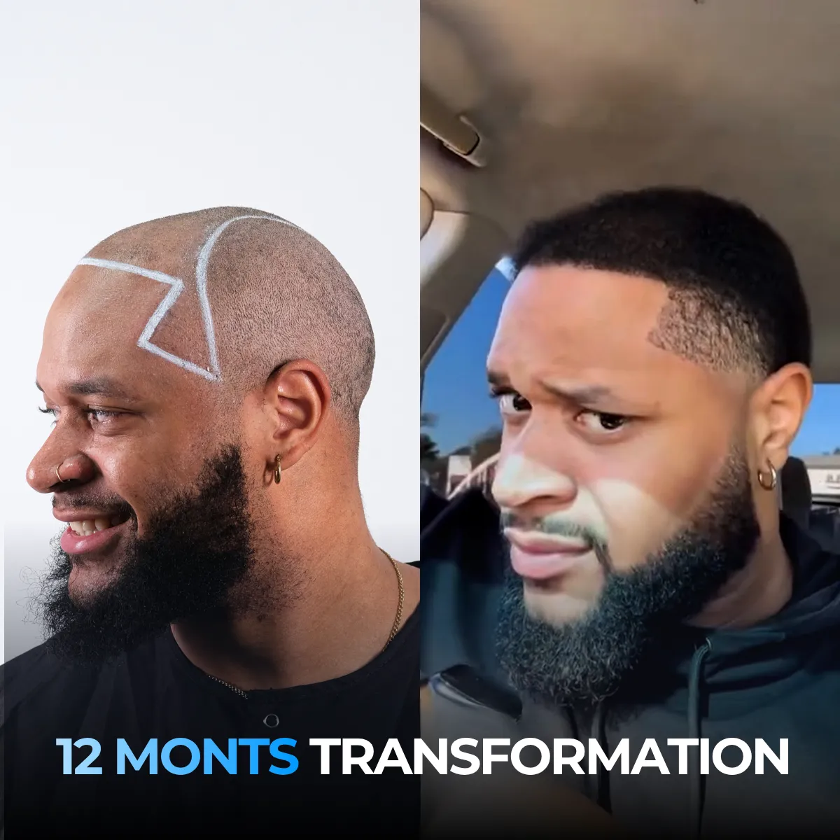 how DHT affects hair, DHT hair follicles, follicle miniaturization, genetic hair loss