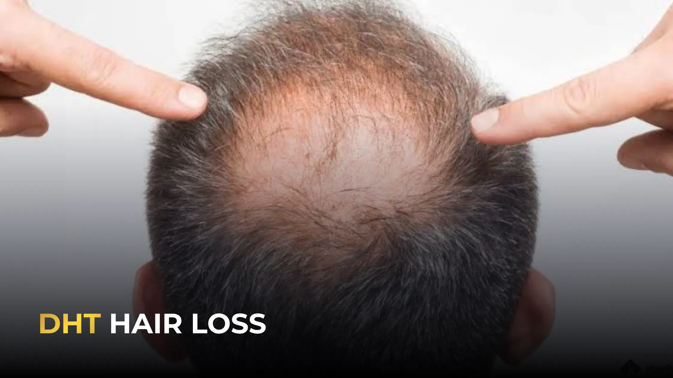 DHT hair loss results, hair transplant transformation, 12 month hair transplant, hair restoration results