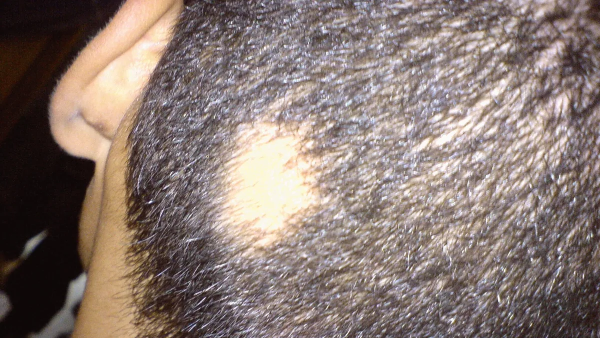 Close-up of the side of a dark-haired head above the ear, with one round, smooth, hairless patch in the short hair