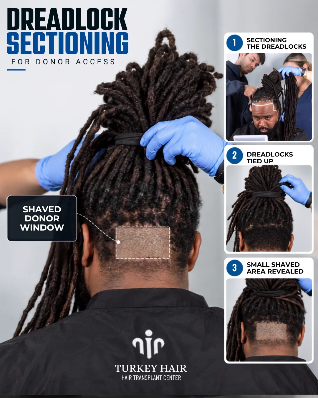 dreadlocks hair transplant before after, dreadlock hair restoration results, Afro hair transplant results, hairline restoration