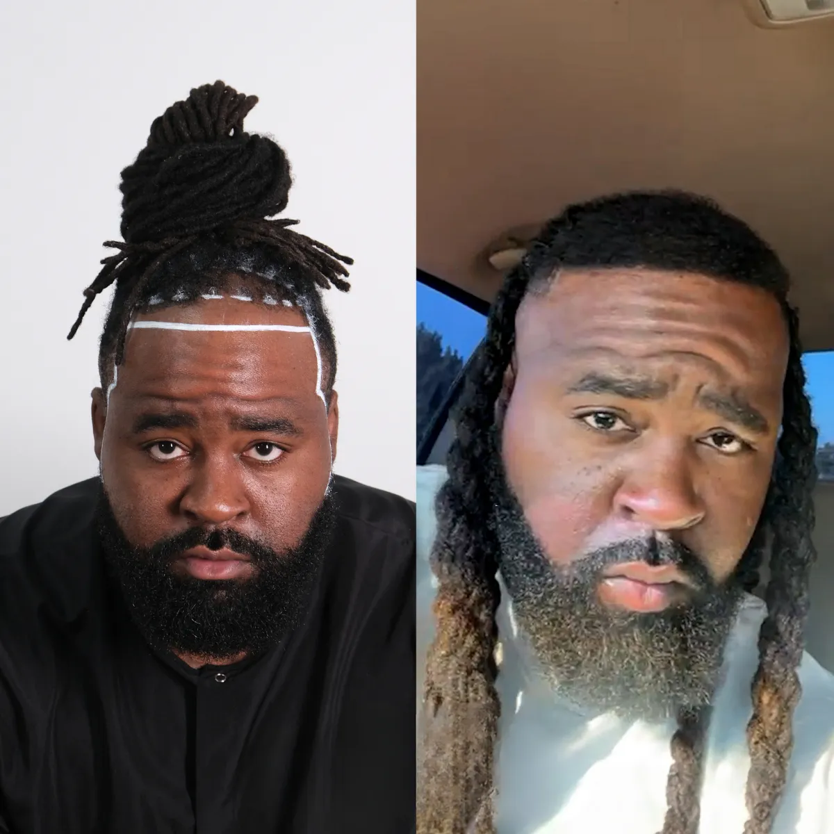 dreadlock sectioning, dreadlocks before hair transplant, hair transplant preparation, Afro hair sectioning
