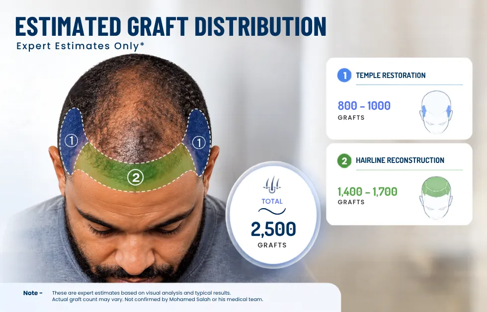 graft distribution hair transplant, hairline design planning, surgical graft count