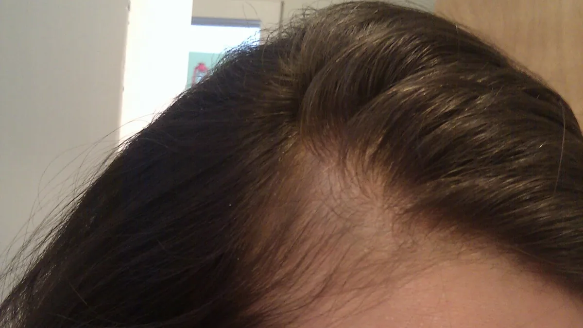 Close view of a woman's frontal hairline with thin, sparse hair at the side of the part after postpartum shedding