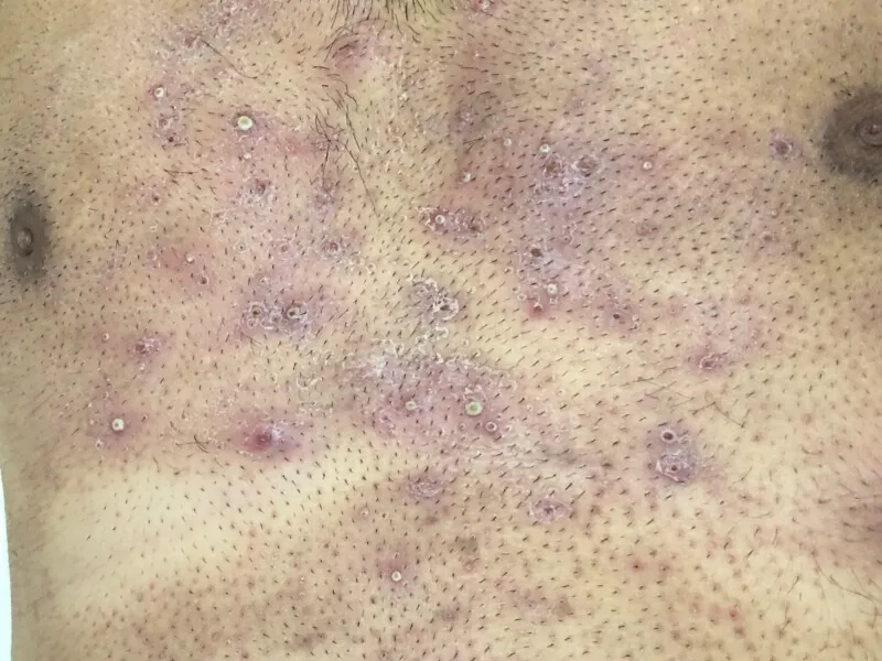 Scattered small red bumps and pustules on shaved chest skin, with dark hair stubble visible between the spots
