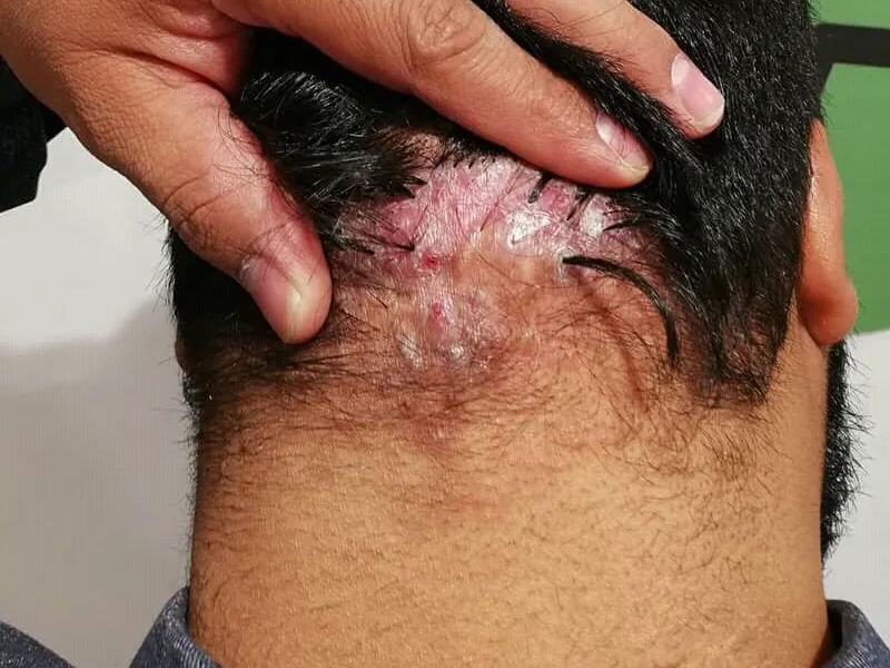 Patch at the back of the scalp with crusts, redness and missing hair, while a hand lifts the surrounding black hair